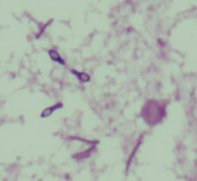 Das Bild zeigt Turicibacter sanguinis mit Endosporen in der Blutkultur (Mikroskopie x100)

The picture shows spore forming Turicibacter sanguinis in blood culture